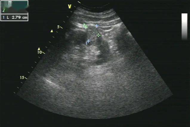 肾细胞癌超声图片