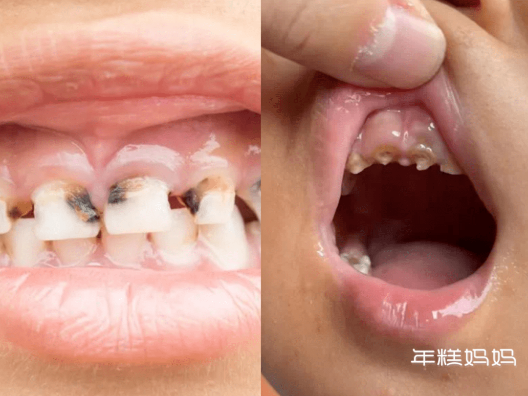 舌癌的早期症状图片 (51)_有来医生