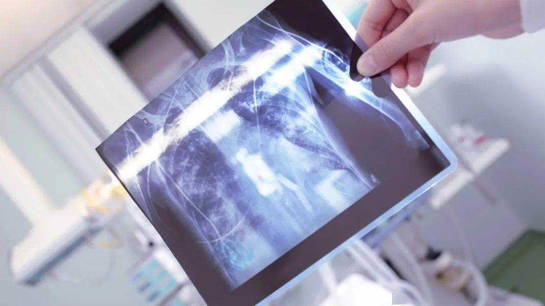 临床上最常用的诊断结核的手段有胸片,ppd试验,结核γ-干扰素释放试验