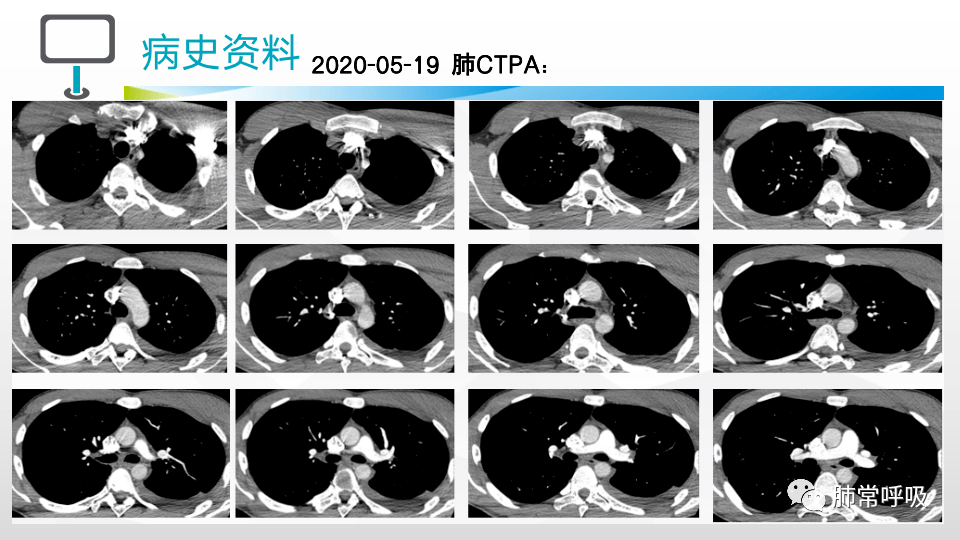 少见的胸腔积液病因之一,您能猜到吗?_mmhg_ml_病史