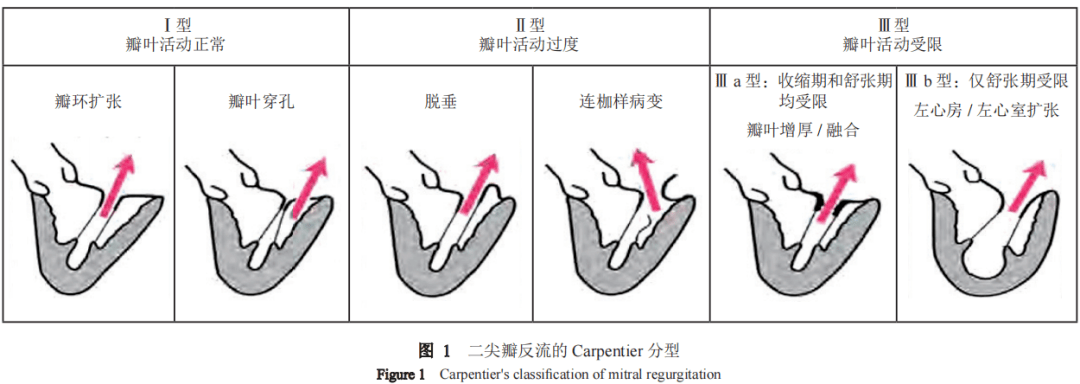 专家共识丨中国经导管二尖瓣缘对缘修复术临床途径（2022版）精简版