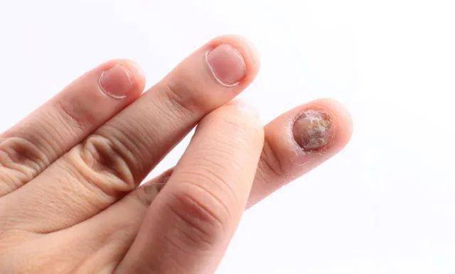 【科普】灰指甲是如何形成的,该如何治疗?_局部_用药量_诊断