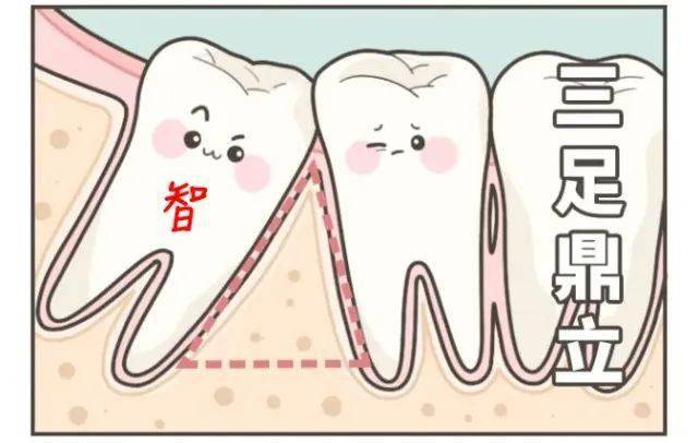 但在出現以下這些情況時,需要考慮拔除智齒——蛀牙,造成相鄰第二磨牙