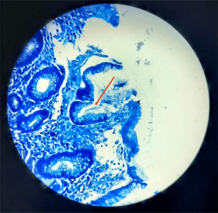 图源:作者幽门螺杆菌(如上图中在黏膜表面聚集的稍弯曲的,蓝染的短