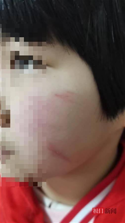 9岁女孩未完成作业被老师打伤面部,当地多方回应_许女士_孩子_女儿