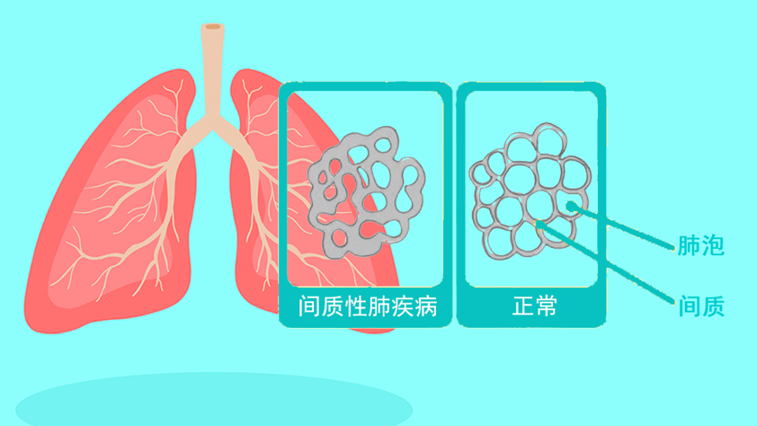 肺纤维化卡通图图片