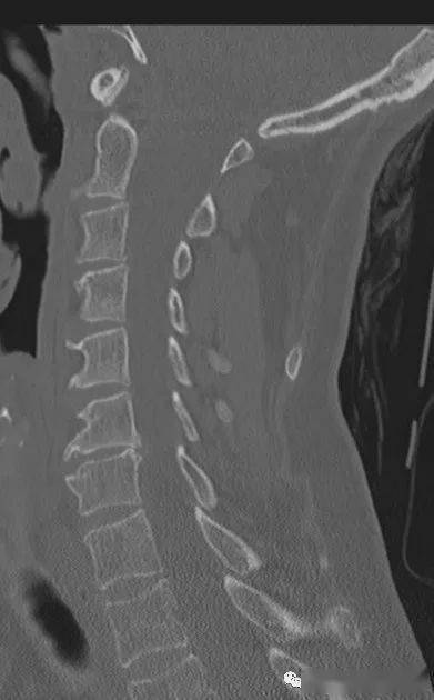一直误认为是项韧带钙化._解剖_颈部_颈椎