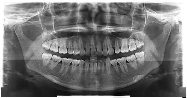 正常牙齿拍片图片