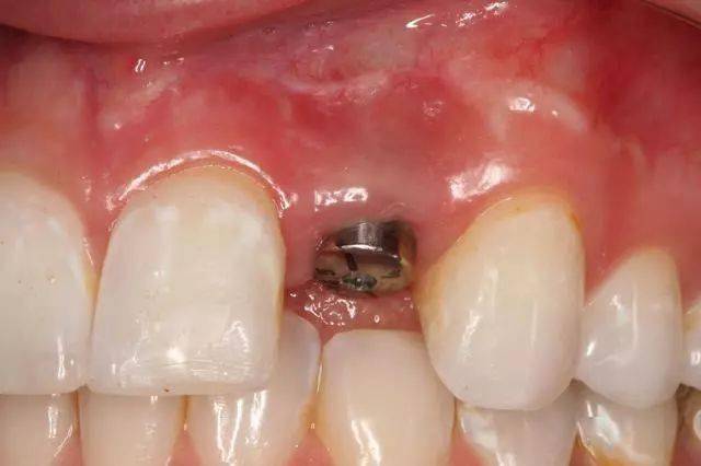 种植牙真的会疼吗?牙医:说种牙很疼的人,其实是没有做过种植牙!