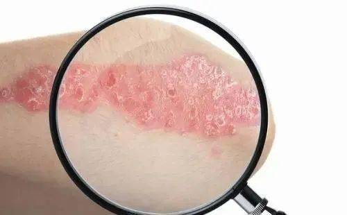 龟头斑 还分三期来检验头干四肢和肘膝 腋下乳房股内甲寻常银屑发病多