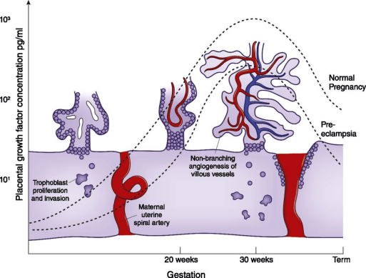 因子是由胎盘滋养层细胞分泌的一种蛋白,能促进90宫螺旋动脉重铸