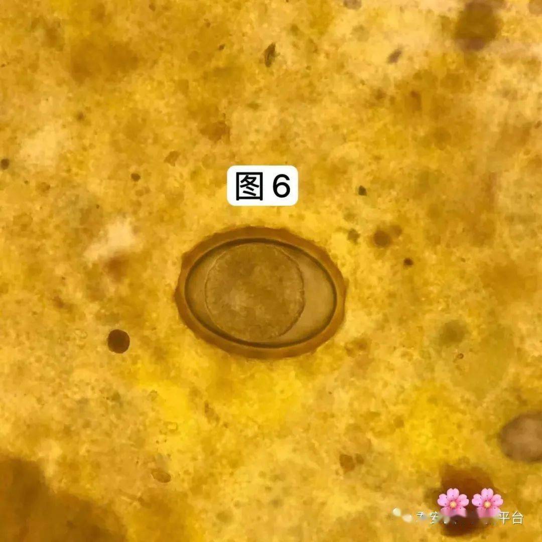 日本血吸虫虫卵铅笔图图片