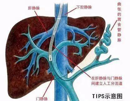 肝门静脉工字部图片