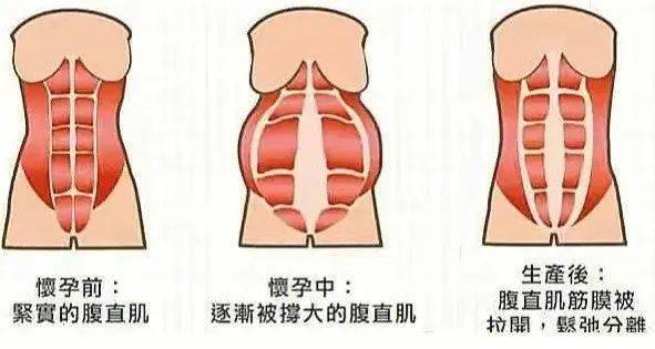 腹直肌分离 | @产后宝妈看过来#孕前"小蛮腰",产后"水桶腰".