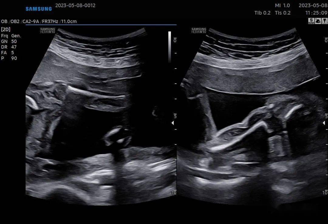 胎儿股骨是哪个部位图片