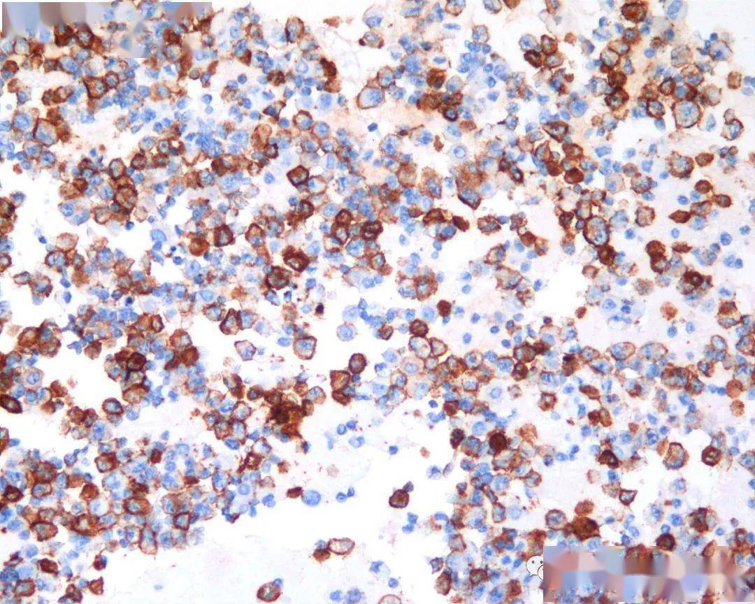 细胞病理浆膜腔积液细胞学标本_检测_分子_临床