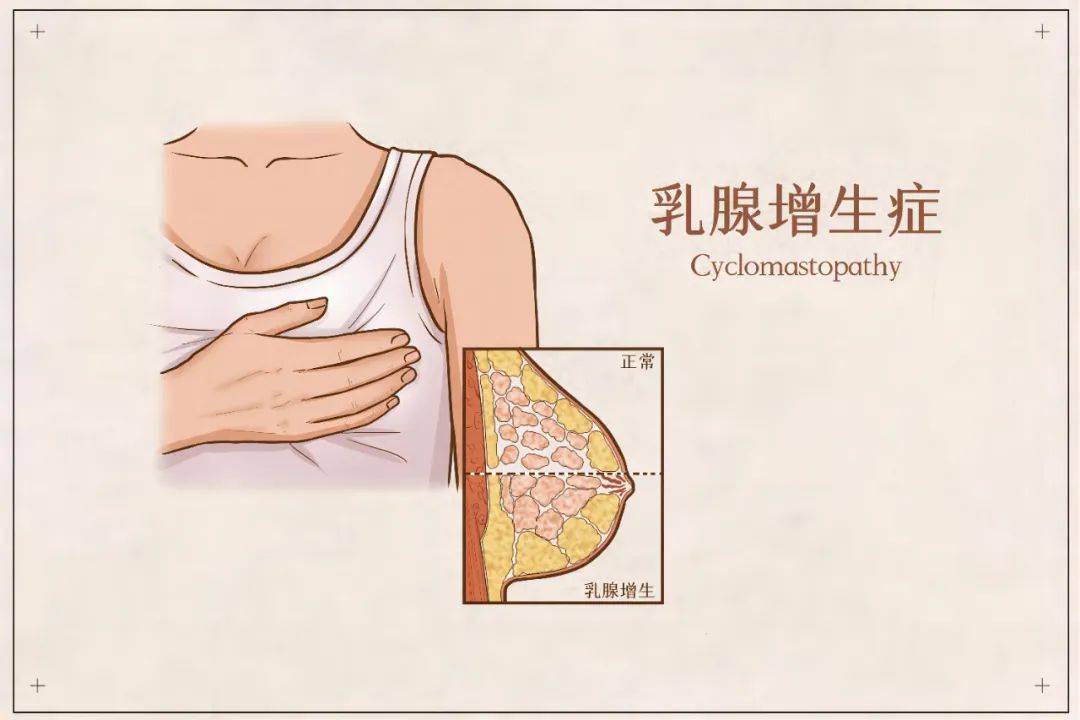 乳腺增生,结节,小叶增生等是体检结果中最常见的字眼,但大多数都是