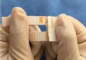 有图有真相:临床最实用的 3 种鼻胃管固定方法任你选_图片_胶带_案例