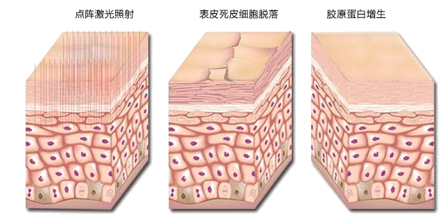 维密治疗原理 #疤痕:阴道口侧切疤痕不明显精致:小阴唇短小对称铰致