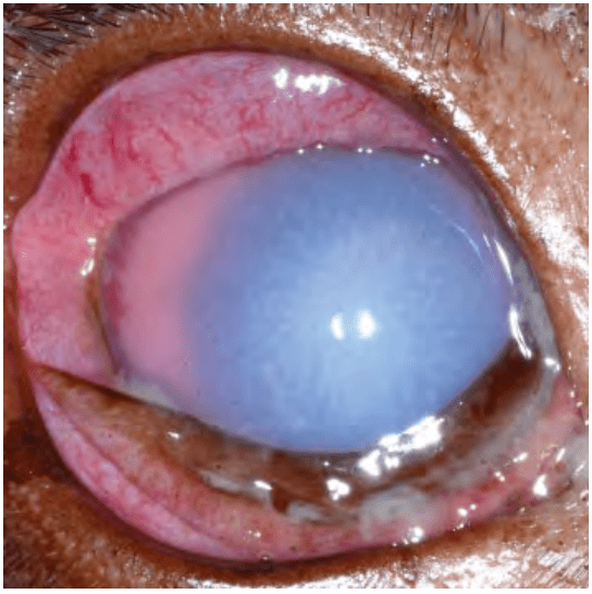 什么是前葡萄膜炎?11张眼科图谱详解症状与诊疗