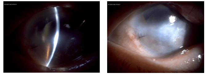 拨雾见光,柳暗花明——赵云娥教授分享角膜异常患者的白内障手术策略