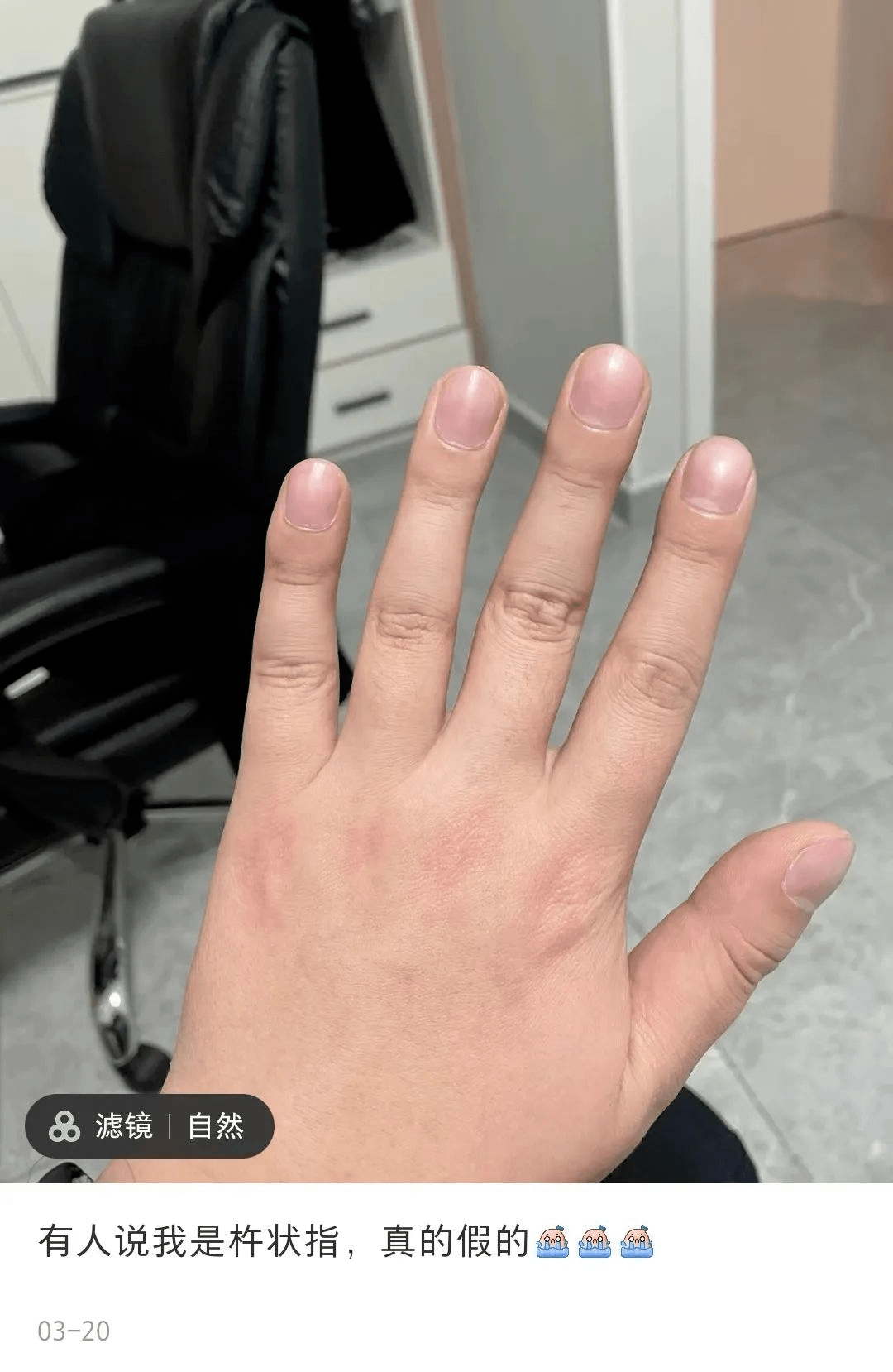 杵状指,民间又称鼓槌指杵状指的表现一般是手指或者脚趾的末梢关节软