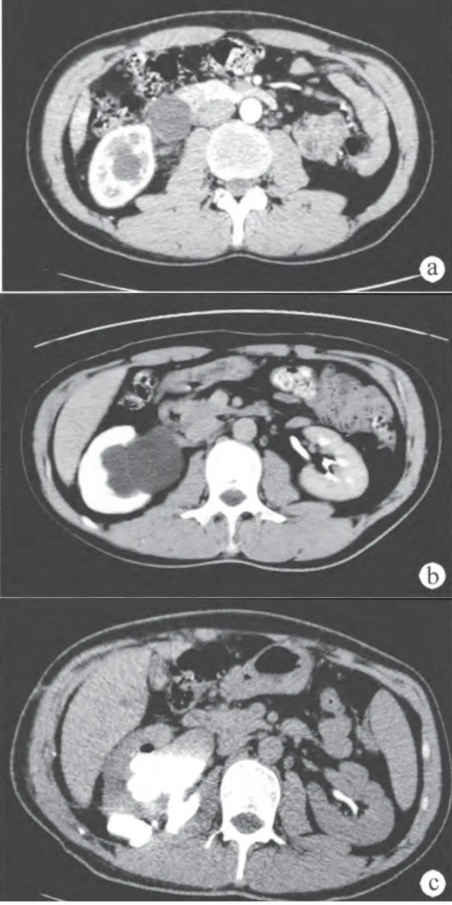 肾盏憩室:肾囊肿的鉴别诊断_输尿管_肾盂_扫描