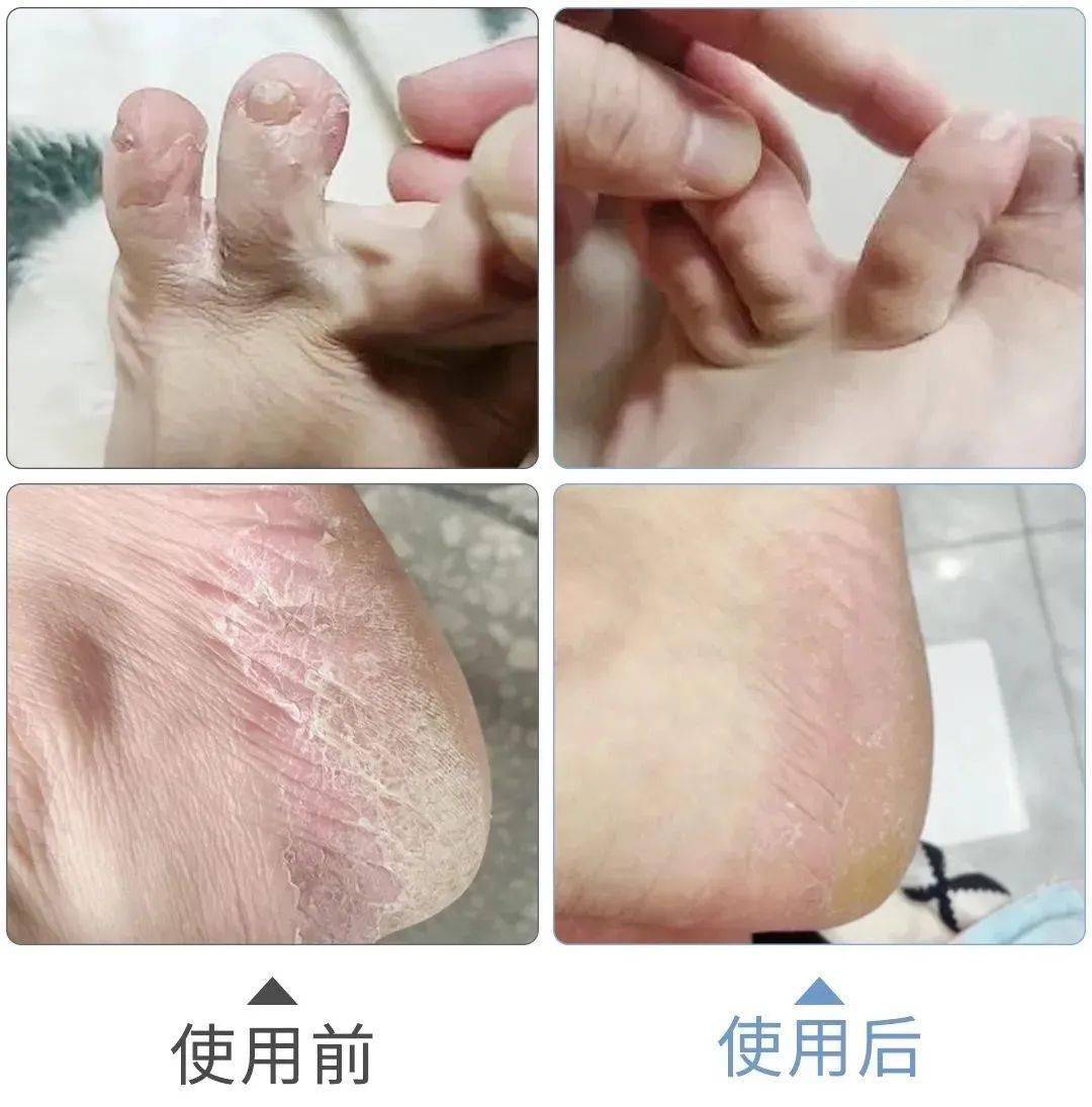 脚气,瘙痒,脱皮?一招让"烂脚丫"消失,不复发!_新西兰_中国_专利