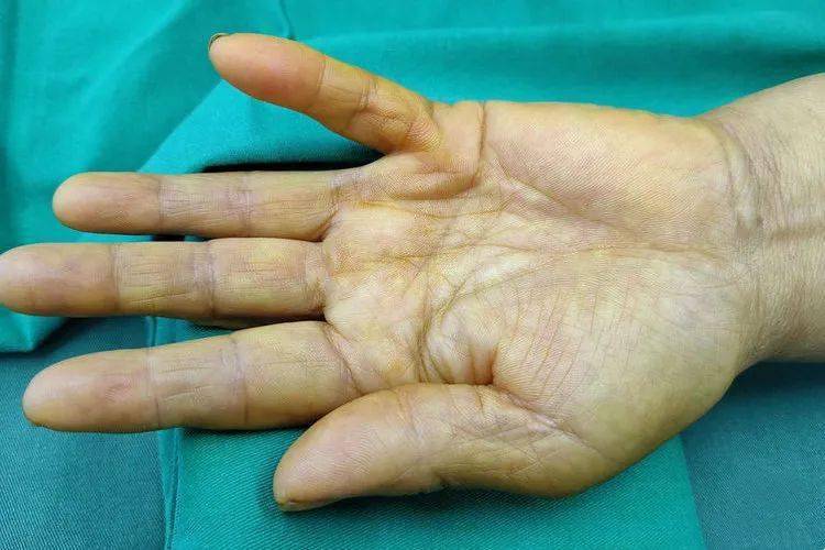 【手足外科】掌腱膜挛缩症——这不是掌中宝,这是肉中刺_患者_活动