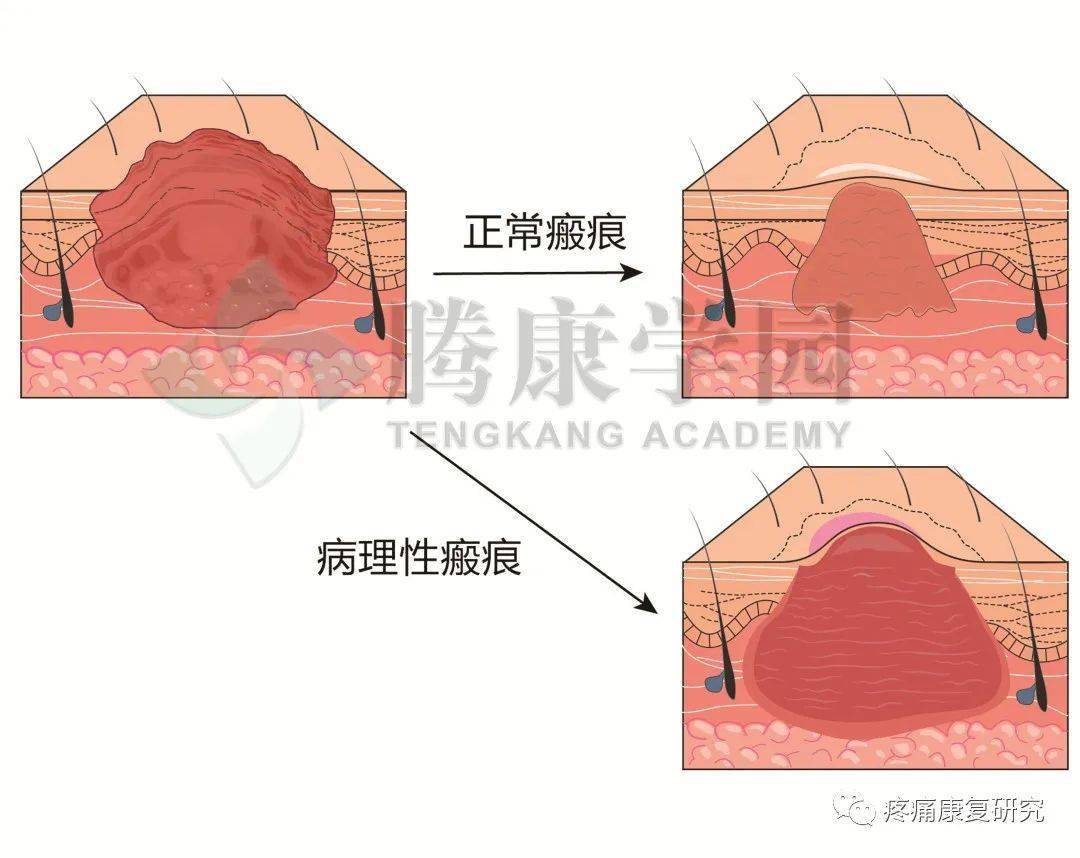 瘢痕组织画图图片