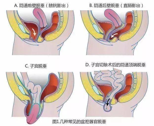 产后膨出 有图图片