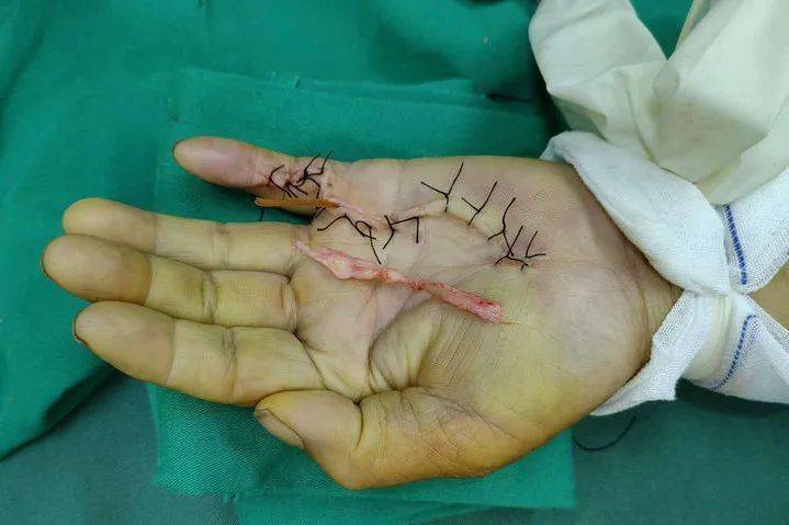 【专科专病】手足外科:掌腱膜挛缩症——这不是掌中宝,这是肉中刺