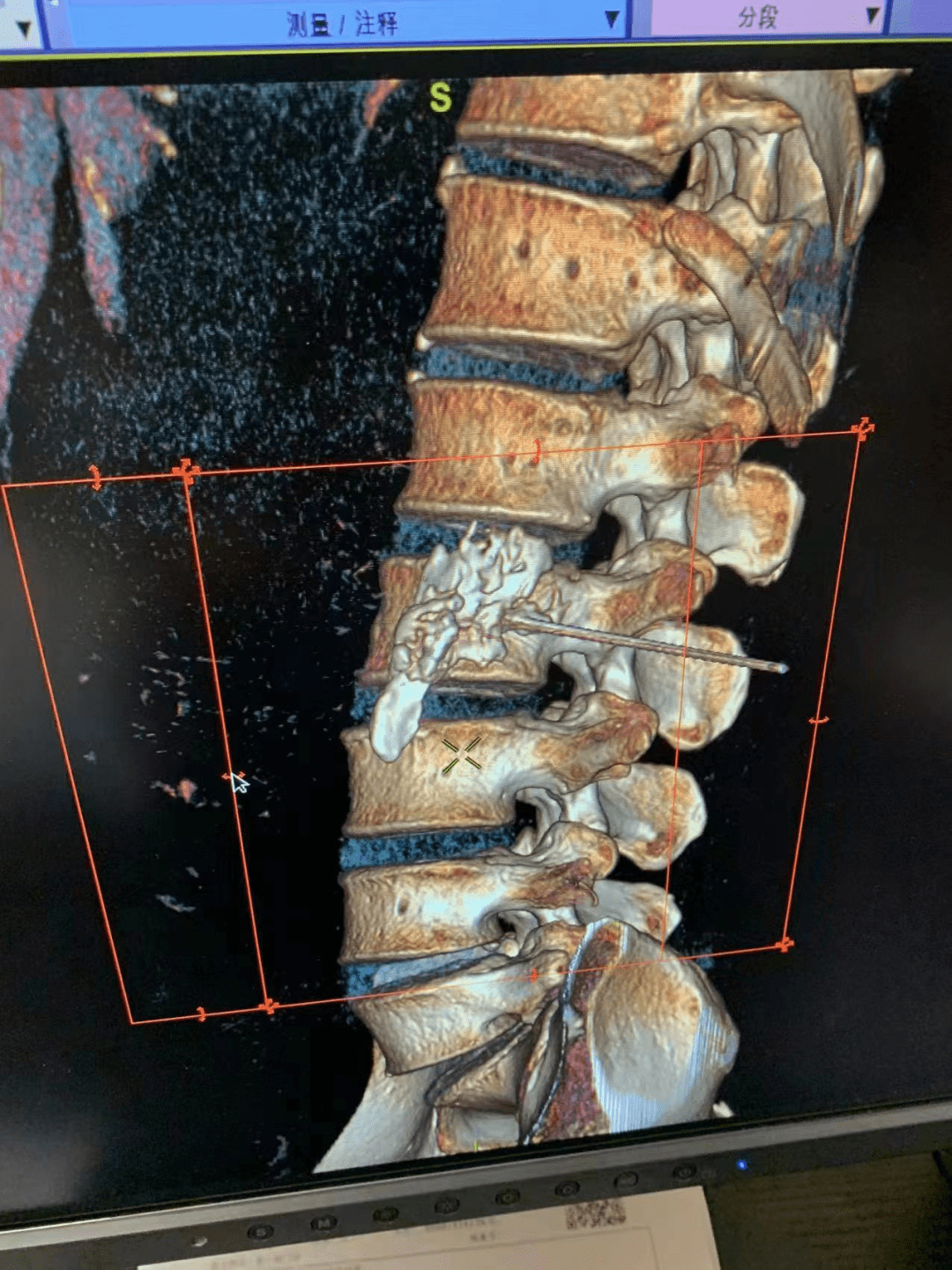 腰交感神经阻滞术图片图片