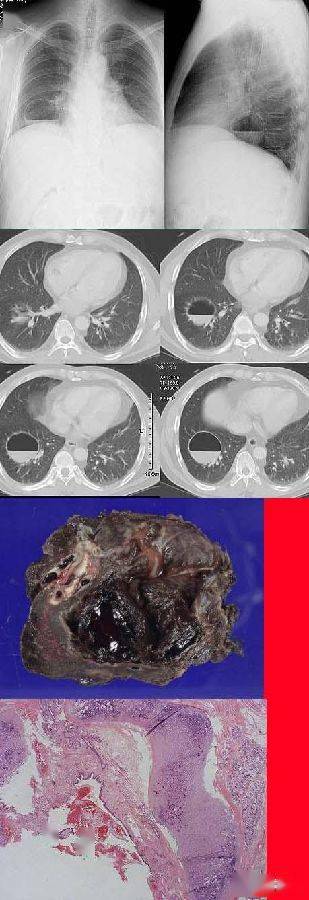 肺囊肿x线图片图片