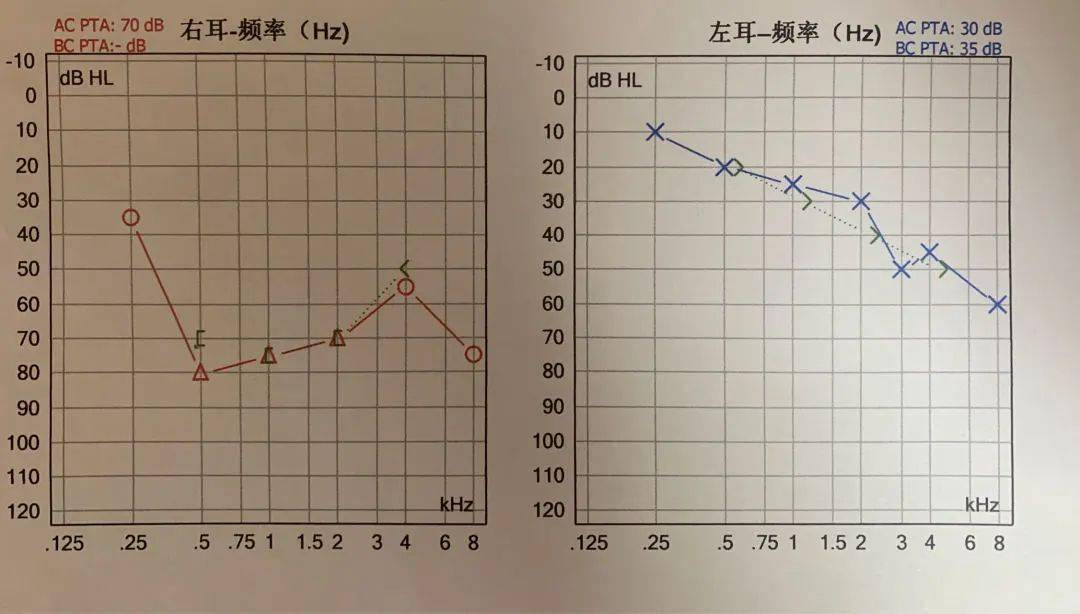 通過電測聽檢查結果顯示: