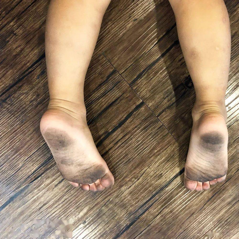 脚脏袜子脏,真的会费妈!说到孩子不爱穿鞋的坏处,真的有一个