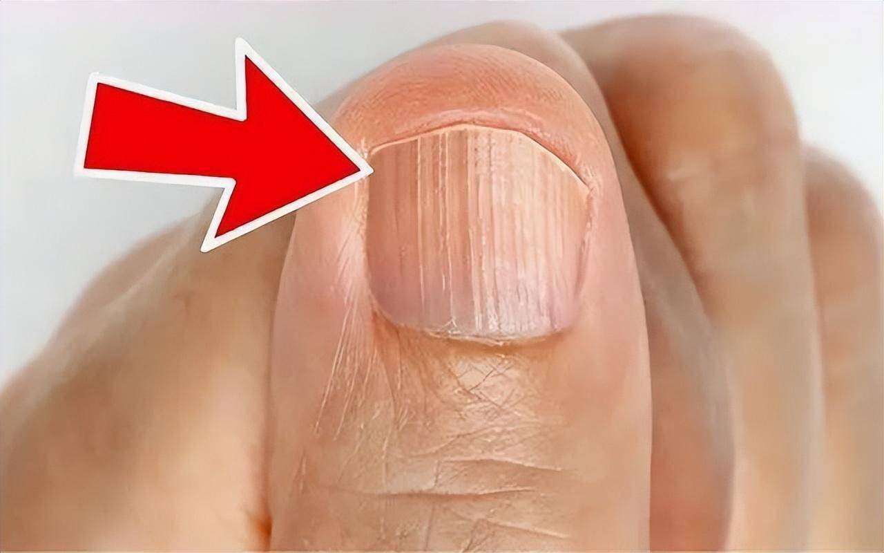 指甲若出现4种异常,或是这几种问题的信号_刘先生_黑色_现象