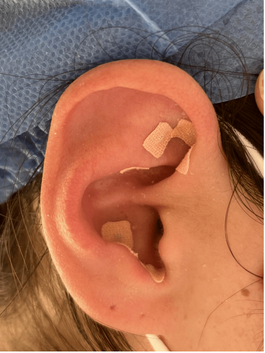 耳穴压豆,揿针辅助治疗:消化不良,慢性胃炎,神经衰弱,头痛,眩晕,失眠