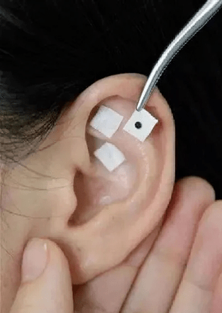 【微健康】耳穴压豆-儿童青少年防控近视小妙招_干预_疾病_标准