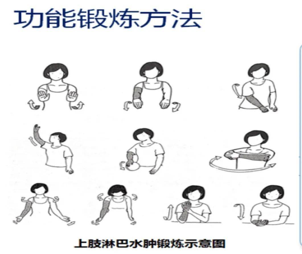 康复中心:乳腺癌术后上肢水肿的康复治疗