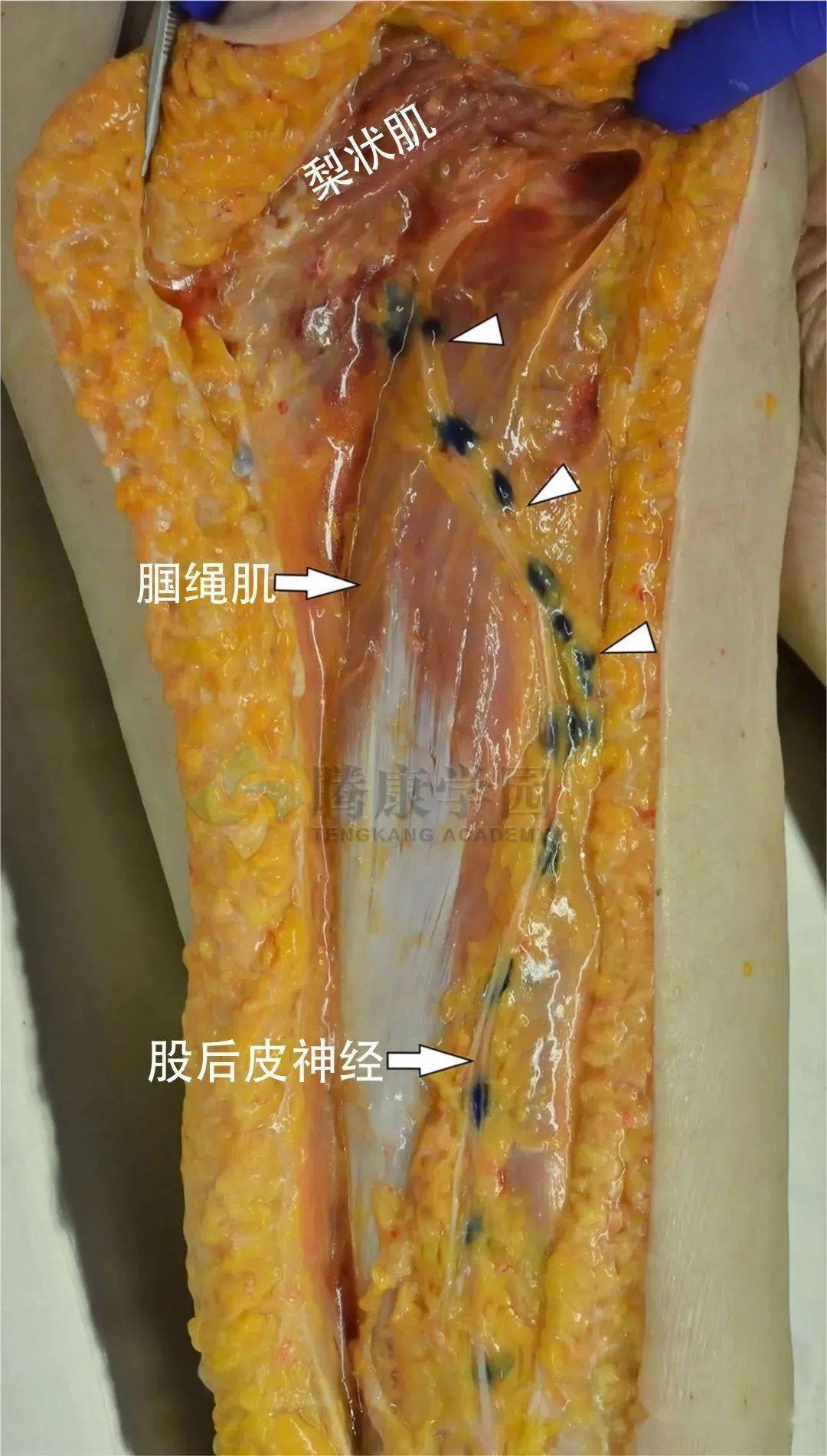 【總結】大腿皮膚疼痛,皮膚病變與皮神經的卡壓損傷_供應_分支_穿過