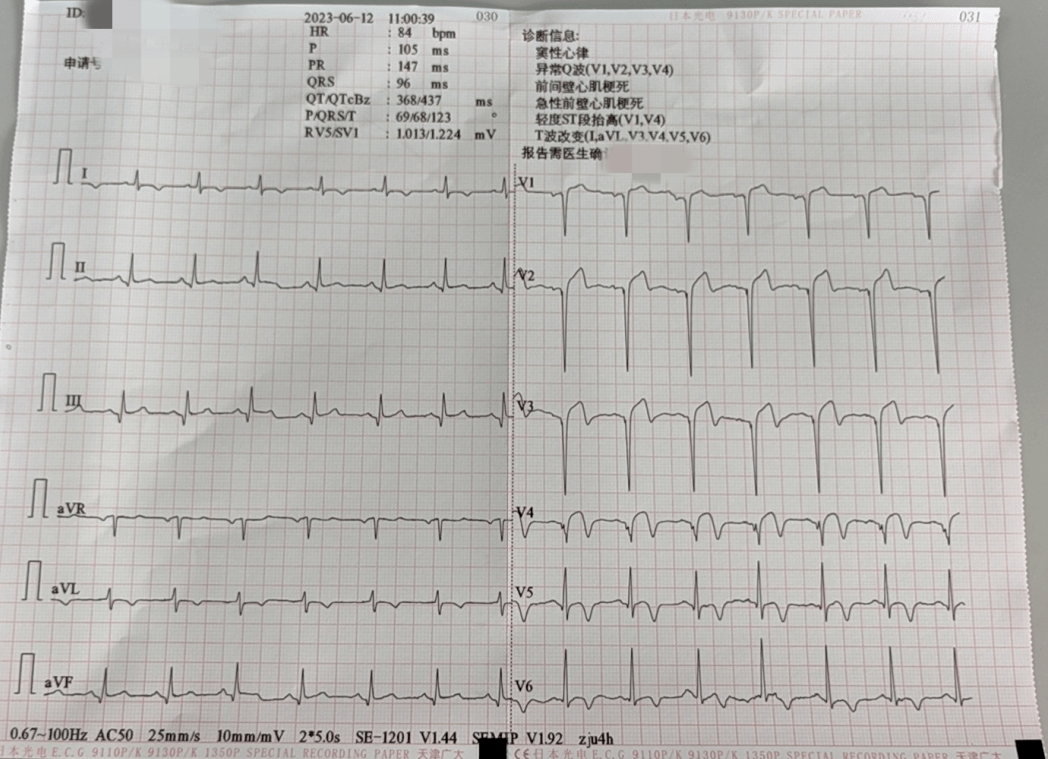 考虑心肌梗死st段抬高异常q波项大爷的心电图危急值报告收到来自心电