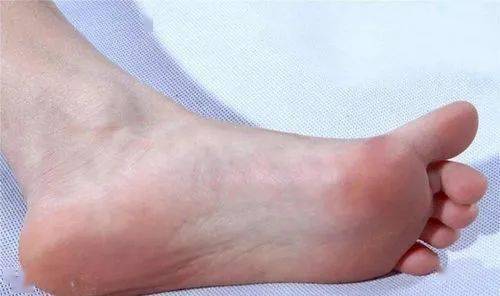 3. 脚底颜色红润人脚的底部,身体比较健康的时候,颜色偏红润.
