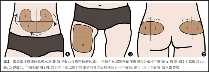 肝素钙打大腿哪个位置图片