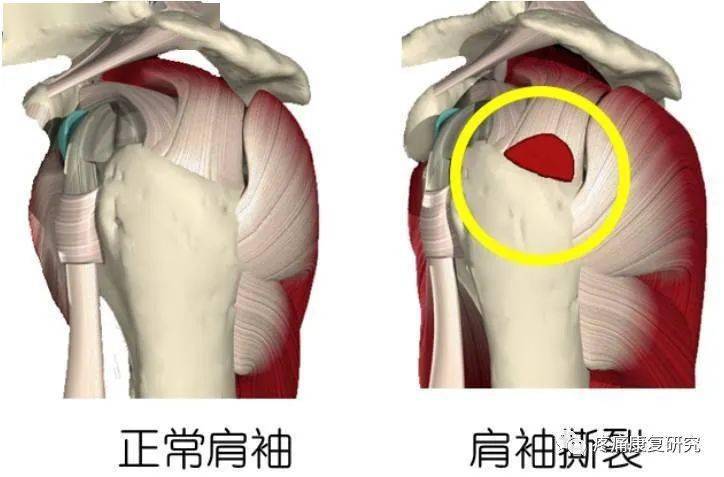 肩袖撕裂的示意图图片