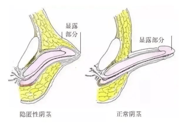 包茎自己割教程 真实图片