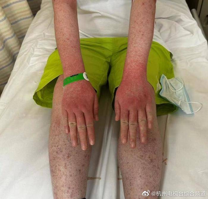 一只小虫叮咬,让女子浑身长满麻子!