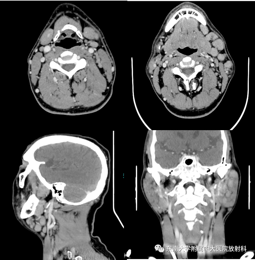 木村病的影像诊断_全网_检查_解剖图
