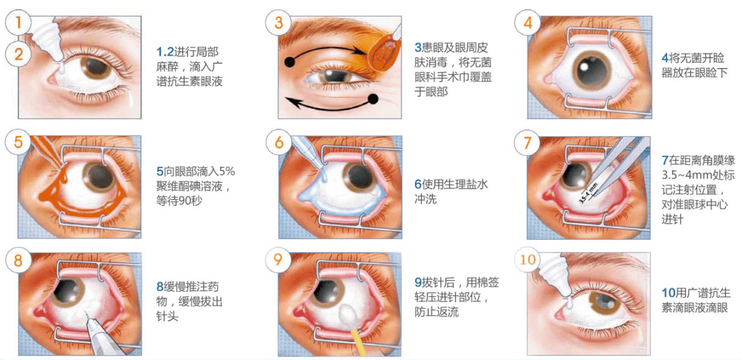 眼科手术铺巾的图解图片