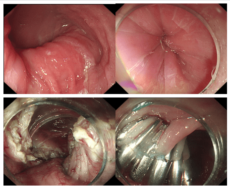 寿光综合医院消化内科开展内镜下食管括约肌切开术_治疗_患者_症状